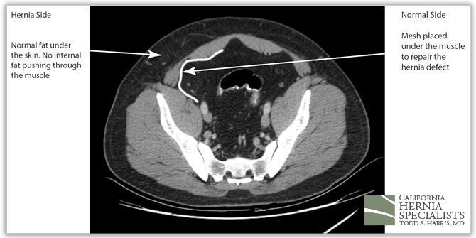 Spigelian Hernia post surgery CT scan image